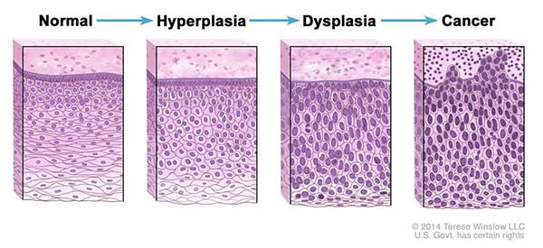 Hyperplasia Dysplasia Cancer Progression Article 1